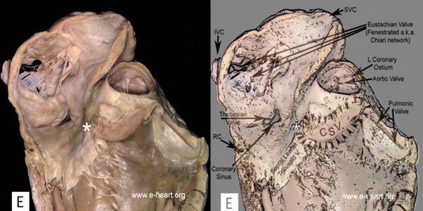 RV Infundibulum